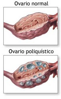 quedar embarazada con ovarios poliquisticos