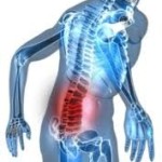 hernia discal hernia discal