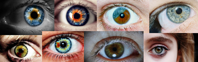 Heterocromia Heterocromia