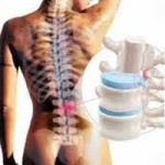 sacroilitis sacroilitis