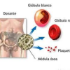 anemia aplasica anemia aplasica