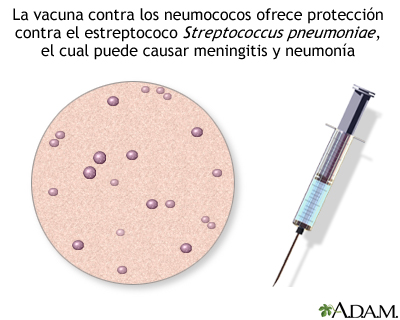 Resultado de imagen para meningitis por neumococo en adultos